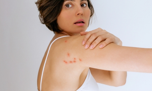 A woman scratches her shoulder bitten by a bedbug.